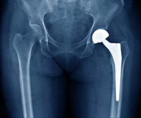 X-ray scan image of hip joints with orthopedic hip joint replacement implant head and screws in human skeleton in blue gray tones. Scanned in orthopedics traumatology surgery hospital clinic