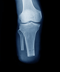 x-ray image of leg amputation front view