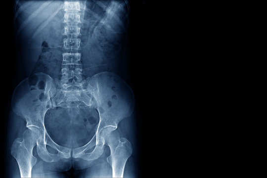 x-ray image of human normal spine, rips, pelvis, both hip joint and blank area at right side