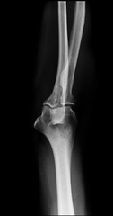 normal elbow x-ray front view
