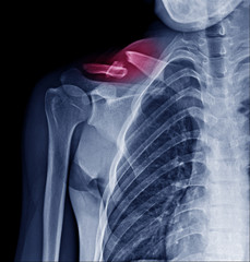 X Ray image of fracture clavicle at red mark area