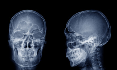 Very good quality X-ray image of normal human skull front (AP) view and side (Lateral) view, Process in blue tone isolated on black background. - obrazy, fototapety, plakaty