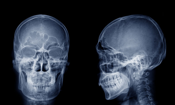 Very good quality X-ray image of normal human skull front (AP) view and side (Lateral) view, Process in blue tone isolated on black background.