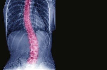 X-ray image of teenager patient spine show Scoliosis and spinal bend in young people. Process in...