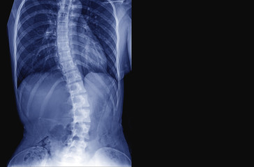 X-ray image of teenager patient spine show Scoliosis and spinal bend in young people. Process in blue tone and have copy space, Medical concept. - obrazy, fototapety, plakaty