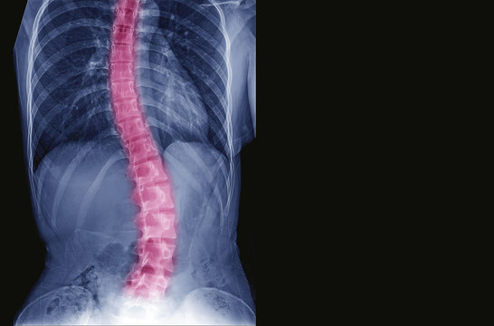 X-ray image of teenager patient spine show Scoliosis and spinal bend in young people. Process in blue tone spine mark in red color and have copy space, Medical concept.