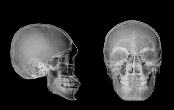 Very good quality X-ray image of normal human skull front (AP) view and side (Lateral) view, Process in normal tone isolated on black background.