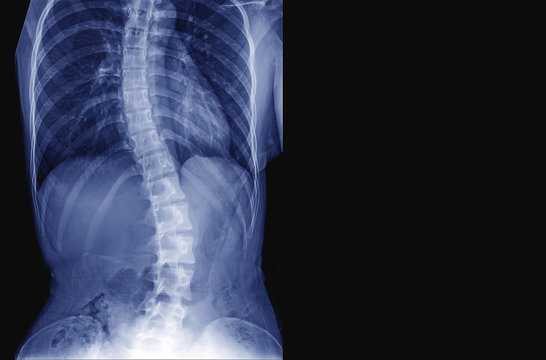 X-ray image of teenager patient spine show Scoliosis and spinal bend in young people. Process in blue tone and have copy space, Medical concept.