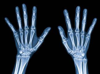 X-ray image of normal women hands isolated on black background with clipping path