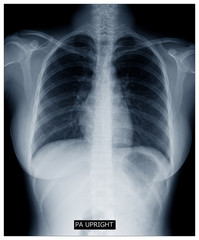 X-ray image of human body chest, very good quality