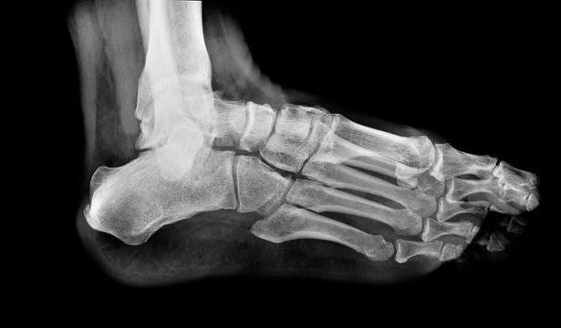 x ray , x-ray image photo of feet side / lateral view.