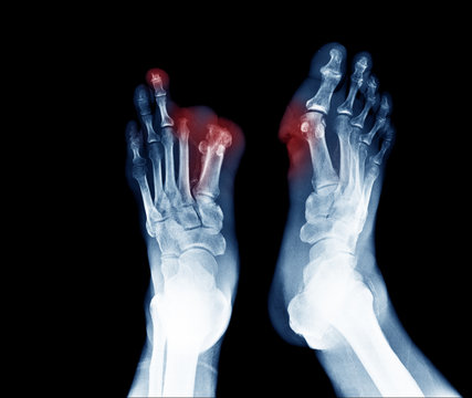 Xray image of diabetic foot ulcer show Joints Collapse and toes amputation