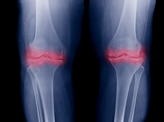 Osteoarthritis Knee ( OA Knee ). Film x-ray both knee ( front view ) show narrow joint space ( joint cartilage loss ) ,X-ray scan of painful knee meniscus injury leg in traumatology hospital clinic.
