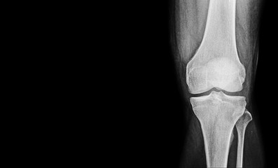 x-ray image of knee with left blank space to add other text