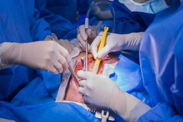 Doctors team wear blue coat perform heart surgery at the operating room in the hospital.