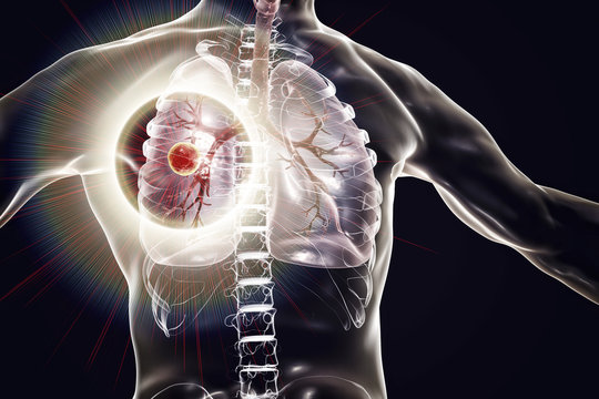 Fibrous-cavernous pulmonary tuberculosis, 3D illustration showing tuberculosis cavity in the lung