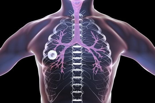 Fibrous-cavernous pulmonary tuberculosis, 3D illustration showing tuberculosis cavity in the lung