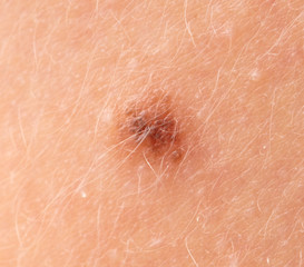 Fototapeta premium Birthmark on the skin as a background