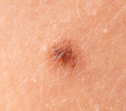Birthmark on the skin as a background