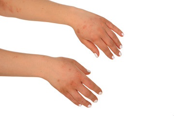 Dermatitis Eczema on the skin of the woman's hands