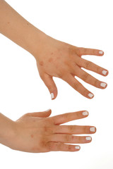 Dermatitis Eczema on the skin of the woman's hands