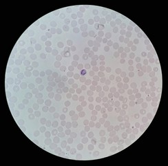 Human parasite on thin film of blood smear with Plasmodium ovale trophozoite form malaria infected red blood cell under 100X light microscope, selective focus.