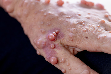 Neurofibromatosis (NF) is conditions in which tumors grow, symptoms include light brown spots on...