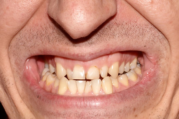 Mouth of man with crooked yellow overlap, crowding teeth close-up, decayed tooth. Not correct,...