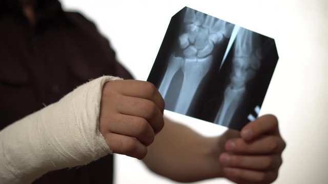 A man with a broken right hand looks at a picture of Rengen. A fracture of the hand led to disability. Health insurance. Close-up