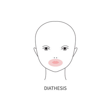 Diathesis in baby