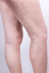 The varicose veins on a legs of woman