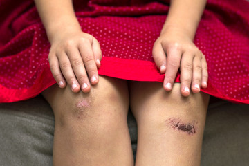Close-up of little girl holding her bruised injured damaged knee with her hands