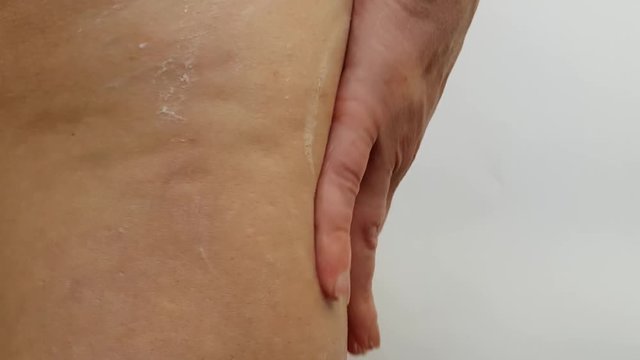 legs of a woman cellulite, cream, hands