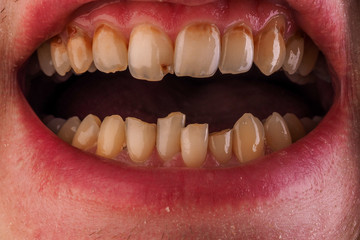 Dental medicine and healthcare - human patient open mouth showing caries teeth decay. Unhealthy denture, tartar on frontal teeth, plaque and gingivitis.