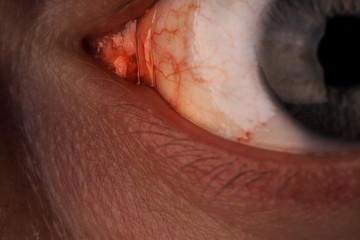 Red eye of a man.