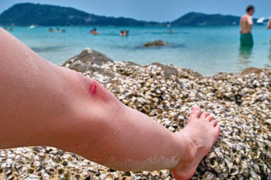 Bleeding on the knee boy. Child wounded his leg against coral reef on tropical beach. Concept of safety when swimming in the sea.
