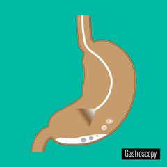 Gastroscopy . Examination of the stomach
