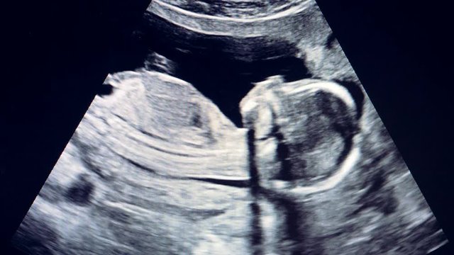 Black and white dynamic ultrasound image of an embryo 