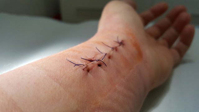 Gebrochenes Handgelenk Operiert