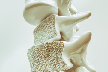 Osteoporosis on the spine - 3d rendering - obrazy, fototapety, plakaty