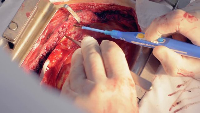 Close up of a cardiovascular surgery process