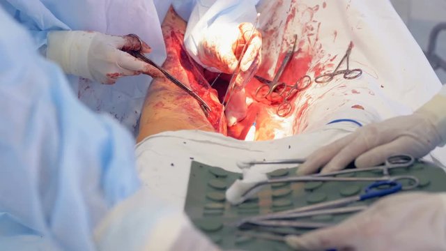 Footage of human leg being operated is getting replaced by image of an operated chest