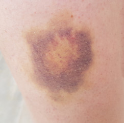 Fototapeta premium gros bleu sur cuisse,conthusion