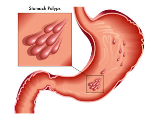 vector medical illustration of the symptoms of stomach polyps