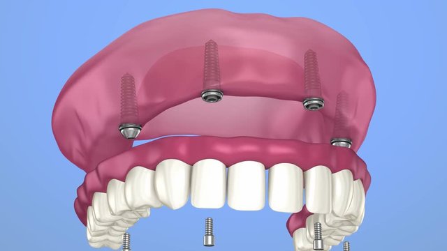 Overdenture to be seated on implants - ball attachments, instalation process. 3D animation