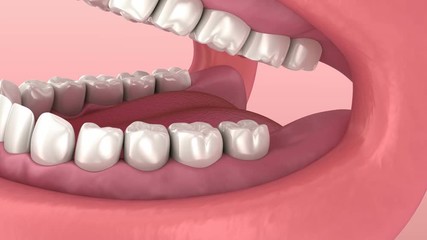Wisdom tooth problem. Medically accurate tooth 3D animation