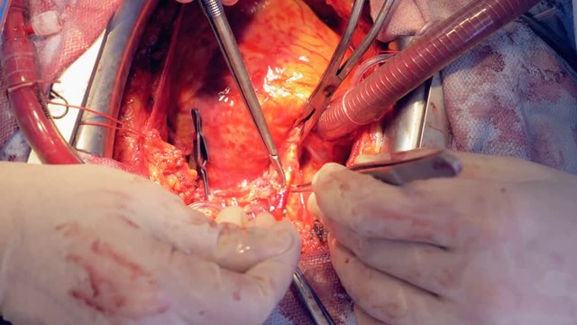 Veins and arteries are being examined during an open heart surgery