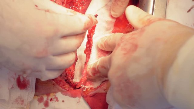 A vessel is being separated and laid down to a piece of gauze during an open heart surgery
