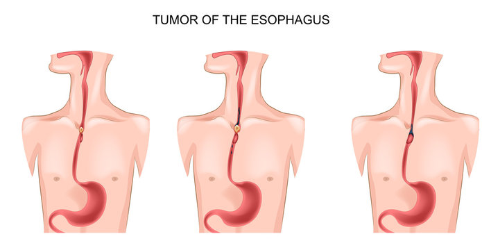 tumor of the esophagus