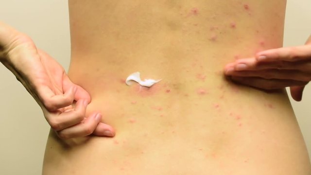 The back of a teenage girl with red acne that she scratches and smears with cream